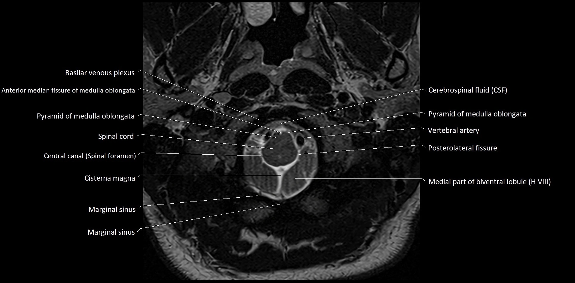 MRI Cerebellar anatomy High-resolution labelled 3T MRI image 1.webp